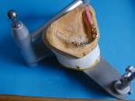 UK Implantatgetragener Zahnersatz