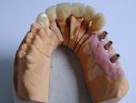 Implantatgetragener Zahnersatz