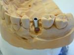 Implantatgetragener Zahnersatz