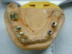 Implantatgetragener Zahnersatz