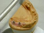 Implantatgetragener Zahnersatz