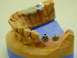 Implantatgetragener  Zahnersatz